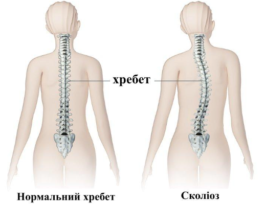 Что такое сколиоз и как его лечить?